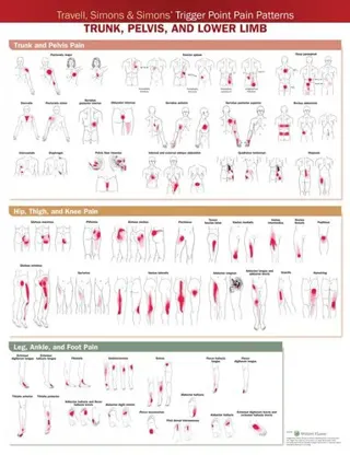 Travell, Simons & Simons’ Trigger Point Pain Patterns Wall Chart
